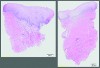 Fig 6. Normal mucoperiosteum with no inflammatory cells seen at both FGG (left) and XCM (right) treatment biopsy sites. At baseline, contralateral matched pairs of root coverage defects are identified.